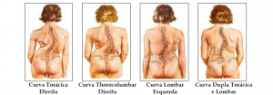Tratamento da Escoliose 3
