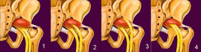 Síndrome-do-Piriforme-5