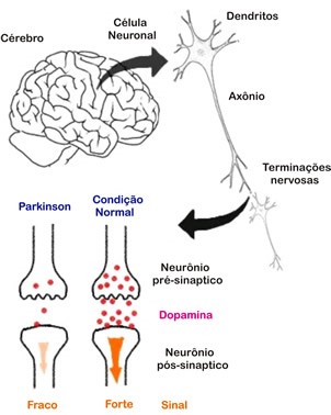 doença-de-parkinson-7