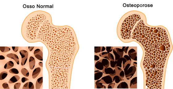 tratamento-osteoporose-(1)