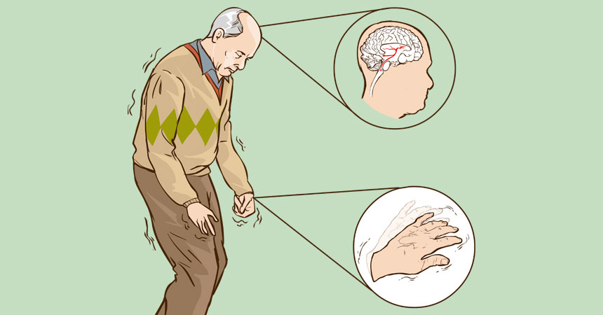 Melhora do Equilíbrio Postural em Portadores de Parkinson