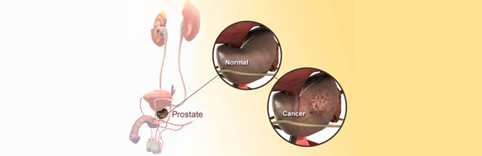 Câncer-de-Próstata
