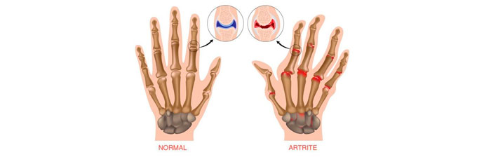 Artrite 4