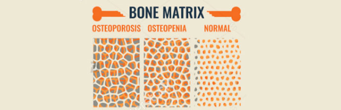 Osteoporose-4