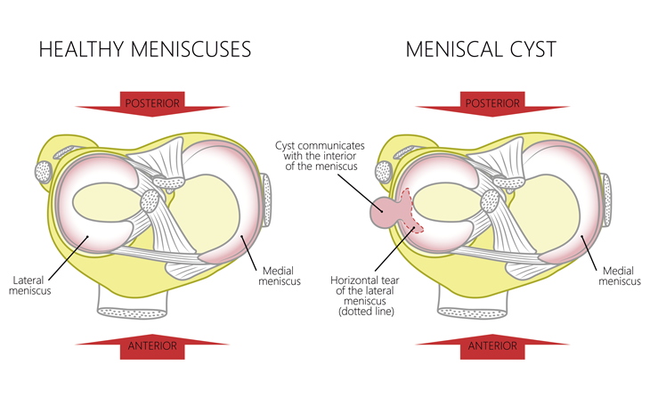 sintomas lesion menisco externo