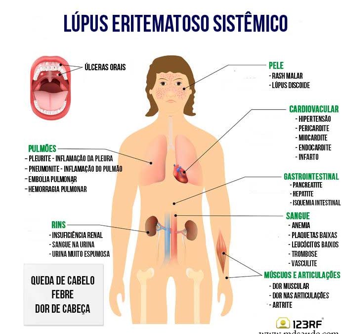 lupus