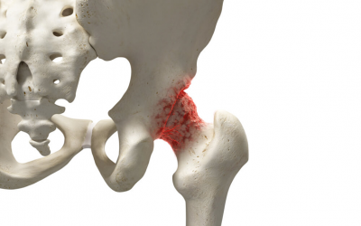 Osteoartrite de quadril: como acontece o tratamento conservador?