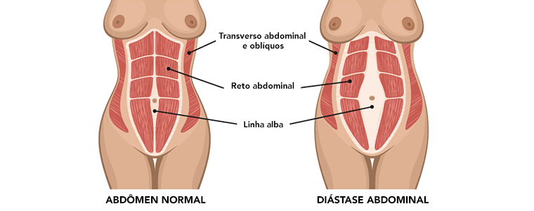 diástase-abdominal-ANATOMIA