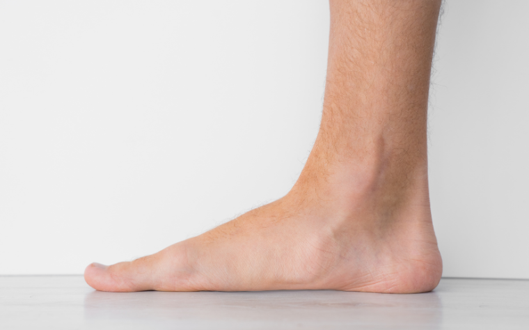 O que é o pé chato e como isso afeta a postura?