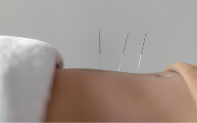 4 mitos sobre acupuntura que você não sabe!